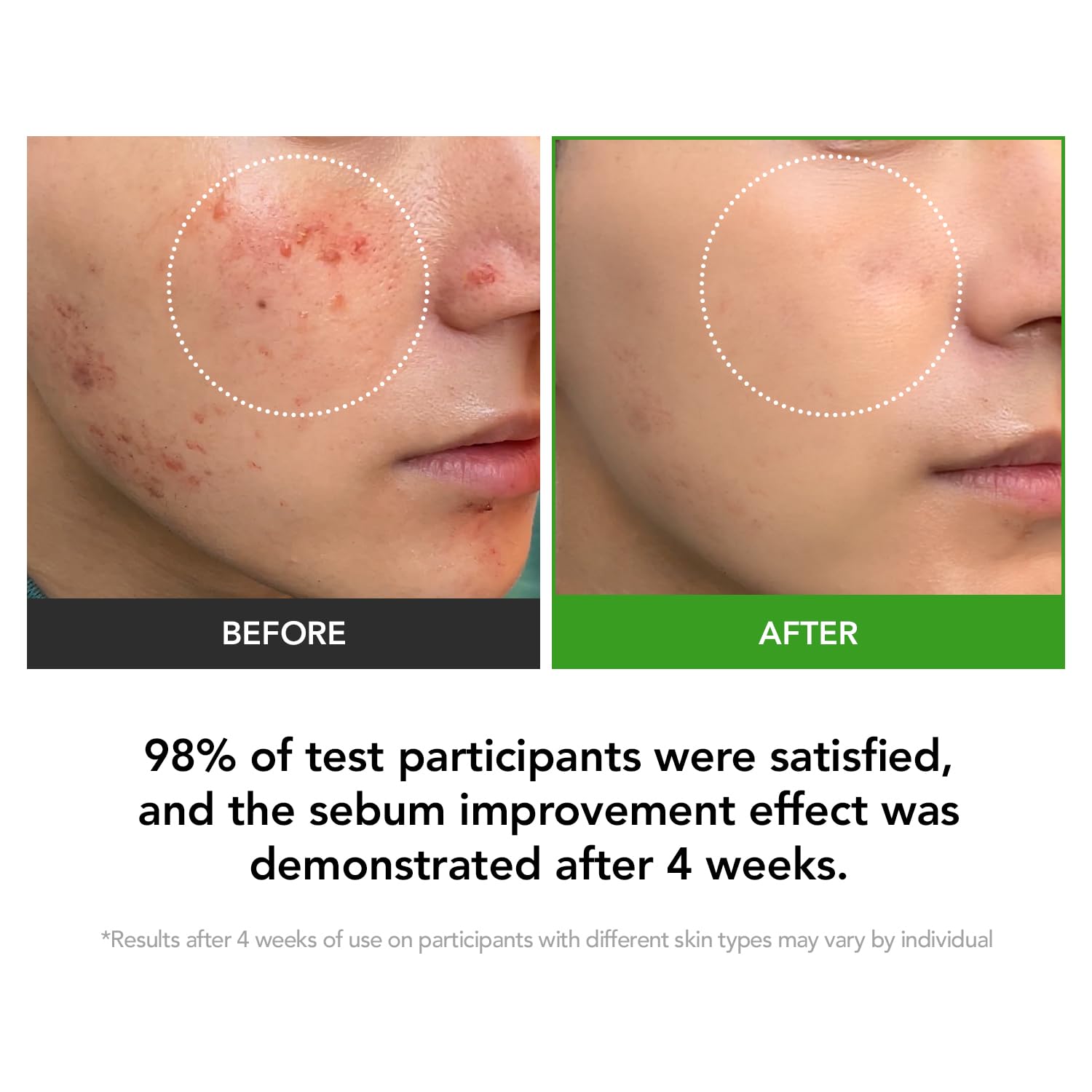 KIOSKIN Heartleaf extract soothing visual emphasizes anti-inflammatory calm for irritated skin.