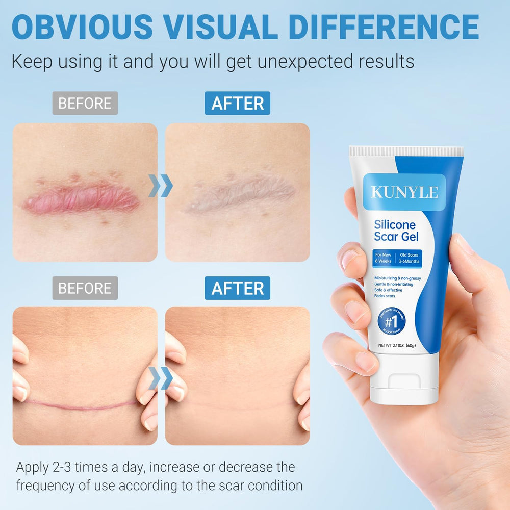 Applying Kunyle scar gel on scar area for softening