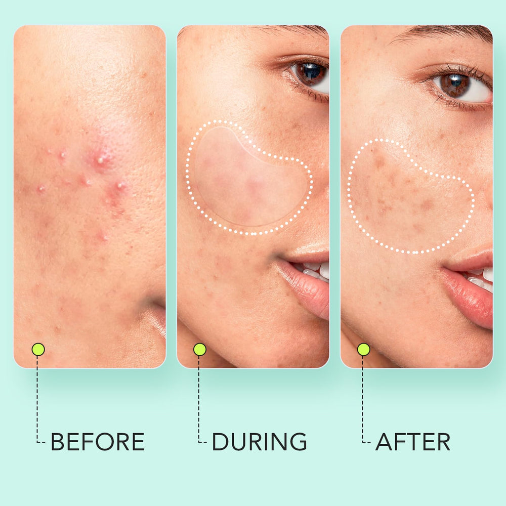 LitBear 26x38mm patch handles mid-sized facial lesions with fast absorption and protection.