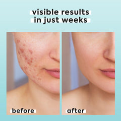 LivaClean hypochlorous spray travel-size ideal for on the go skincare