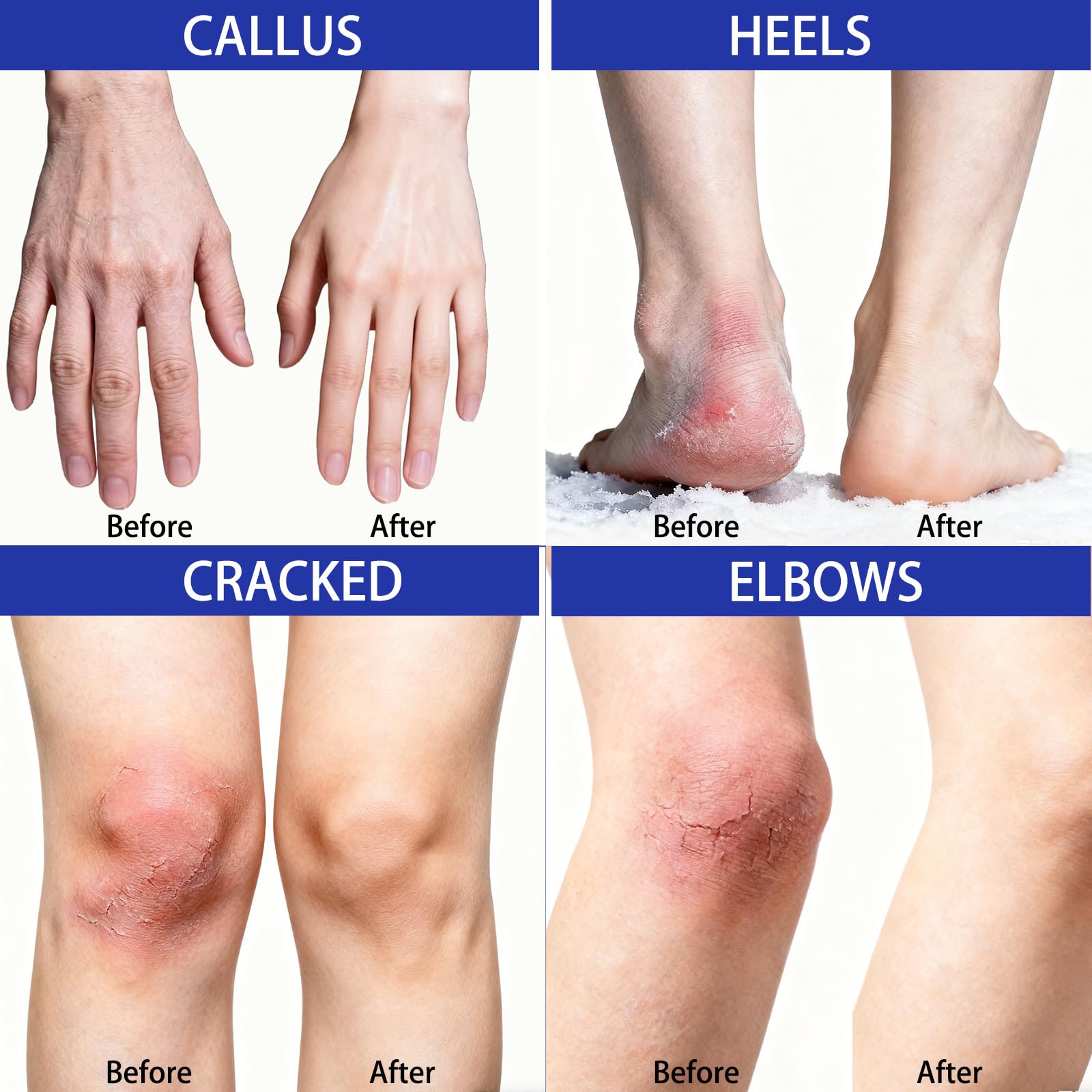 LOLX 40% Urea Cream targeting cracked skin and calluses