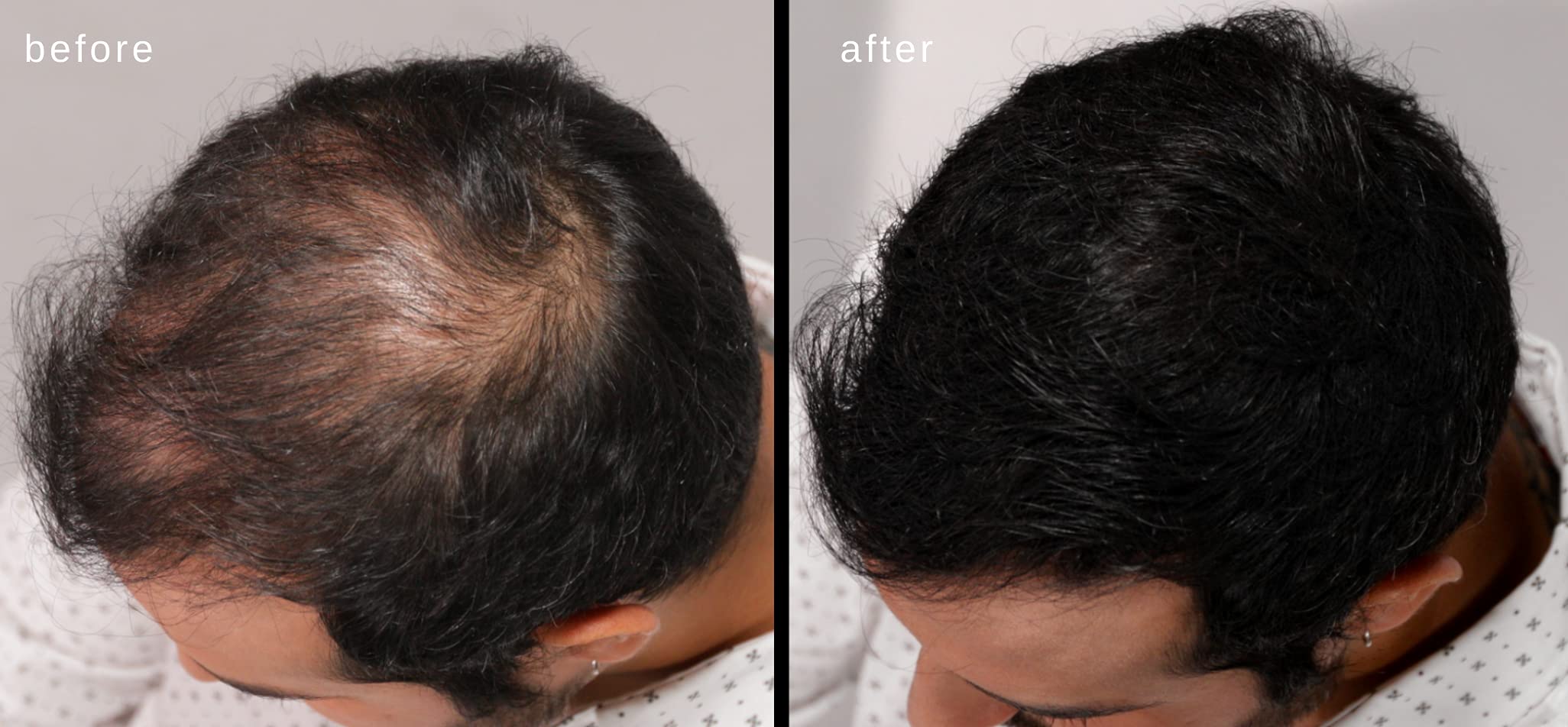 LUXE Hair Building Fibers dermatologist-tested and hypoallergenic for sensitive scalps.