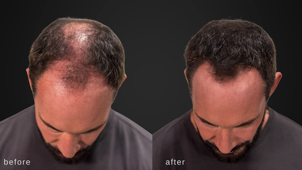 LUXE Hair Building Fibers hypoallergenic formula minimizes irritation and skin sensitivity.