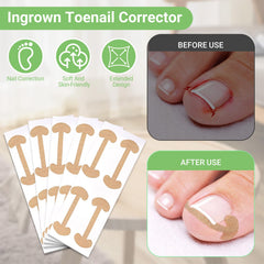 LYNRUI easy-use corrector patches support gentle nail growth guidance.