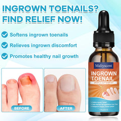 Maliyscent Ingrown Toenail Drop on an affected toe illustrating soothing care