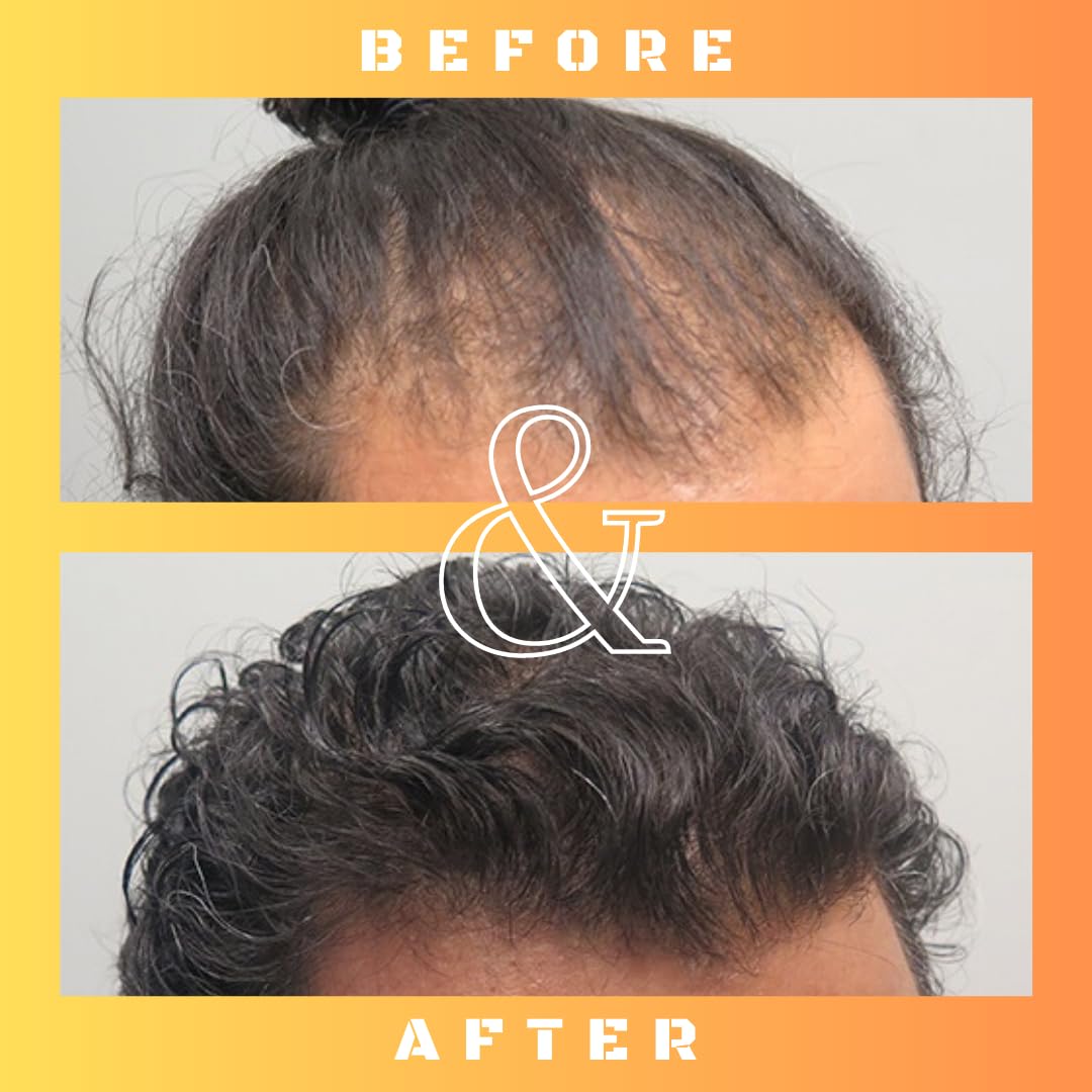 Mane Regain RU58841 5 percent scalp application in use