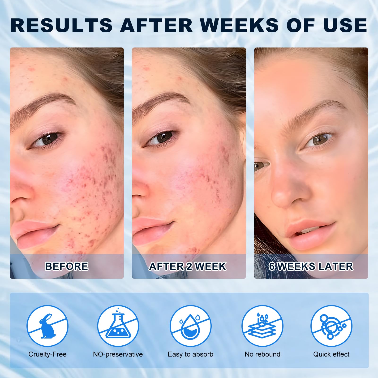 Marianp Azelaic Acid Cream application on hand demonstrates easy daily use.