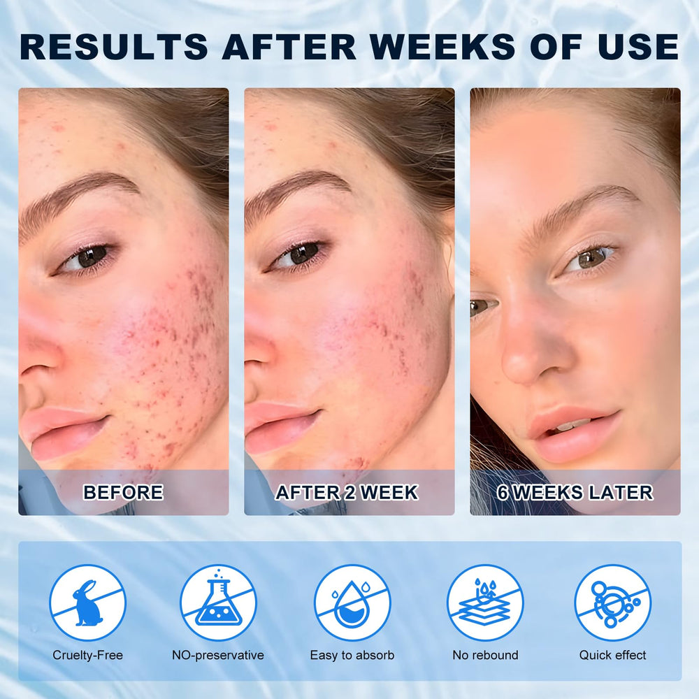 Marianp Azelaic Acid Cream application on hand demonstrates easy daily use.