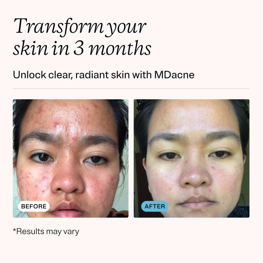 MDacne cream texture close-up showcases a light, non-drying finish for sensitive skin.