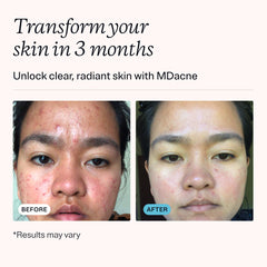 MDacne cream texture close-up showcases a light, non-drying finish for sensitive skin.