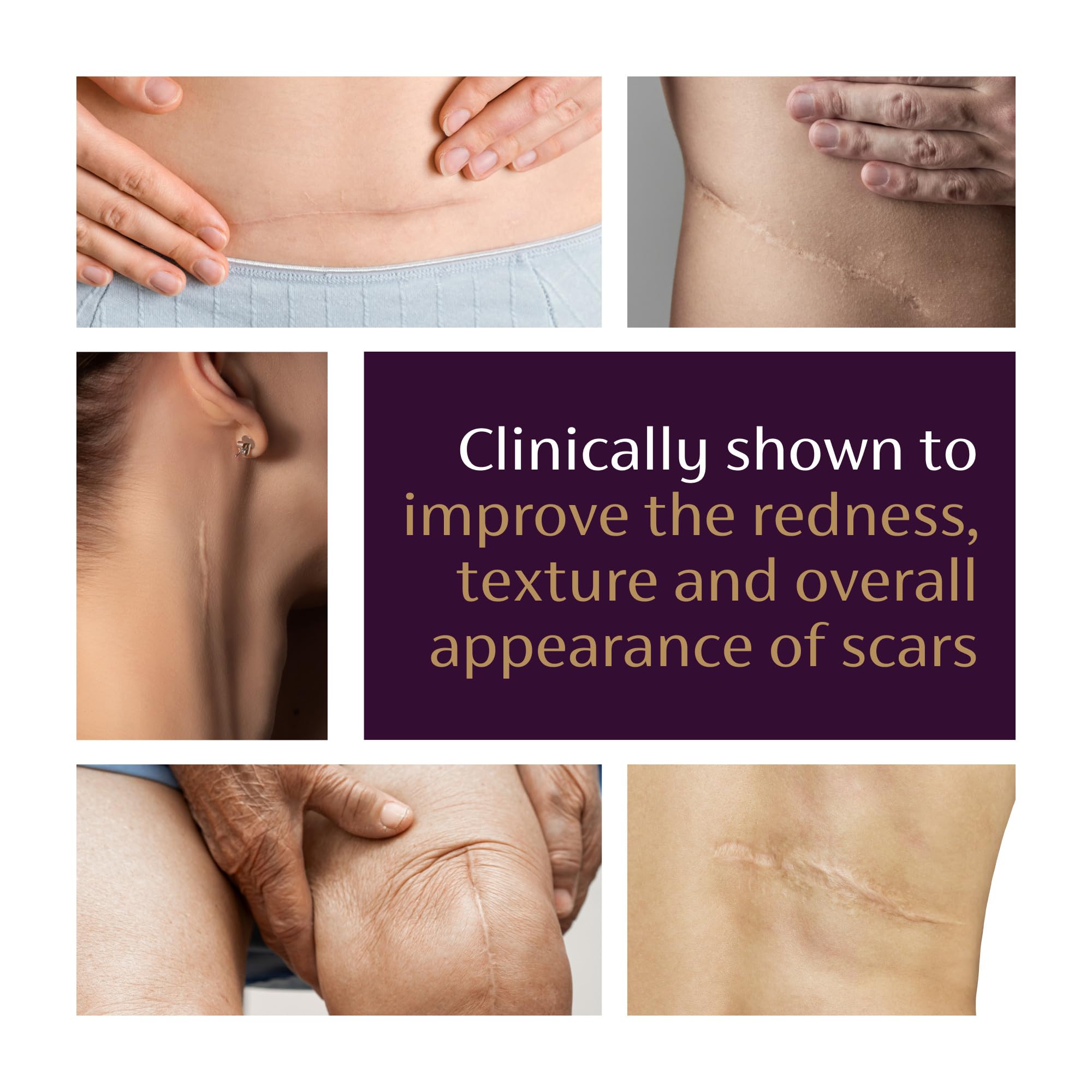Illustrated before and after using Mederma showing improved scar texture appearance