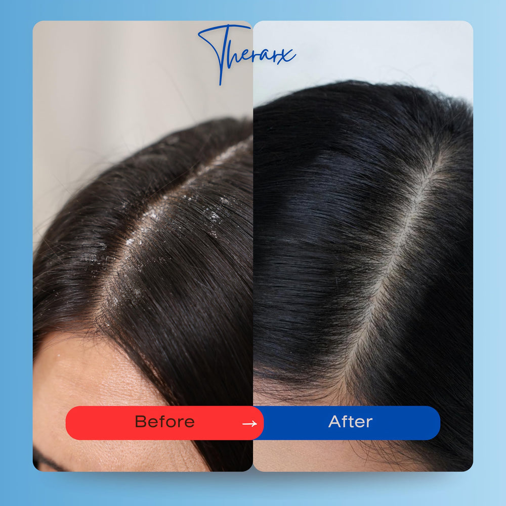 Mediceuticals TheraRx antibacterial scalp wash label image aids quick product identification.