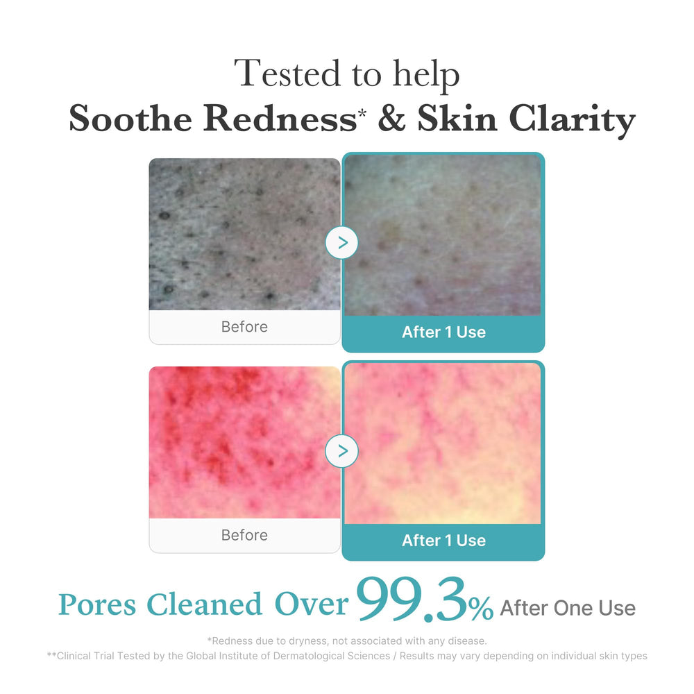 medicube Azelaic Acid Gummy Whip Cleanser pores close-up shows refined appearance after cleansing.