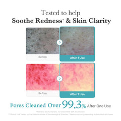 medicube Azelaic Acid Gummy Whip Cleanser pores close-up shows refined appearance after cleansing.