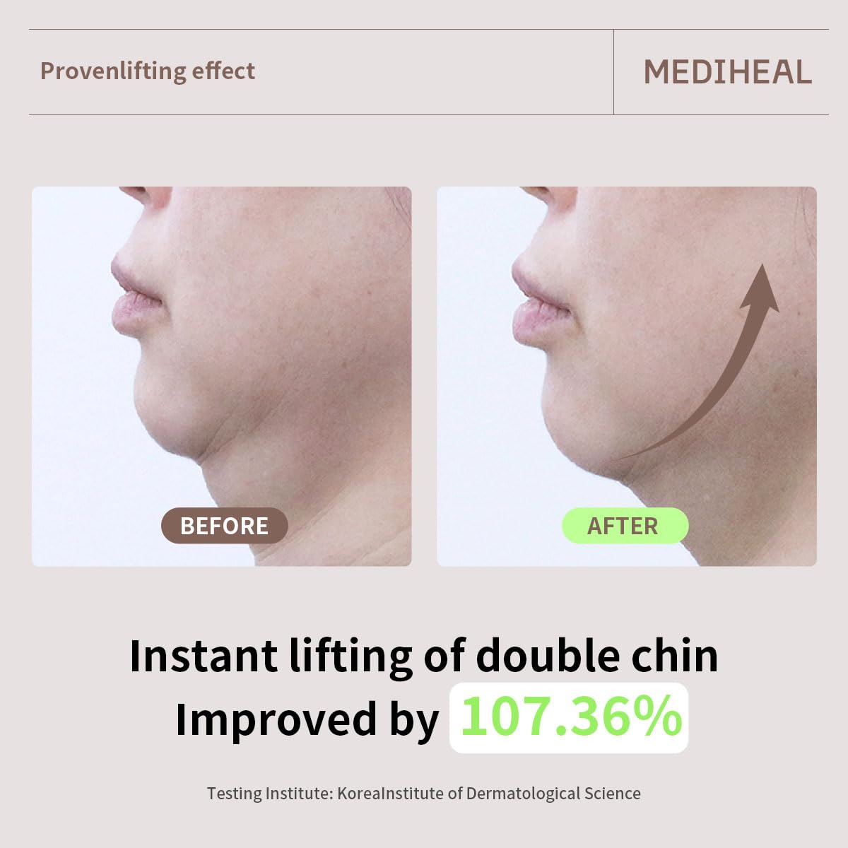 V-line area focus showing potential lifting around jawline with Mediheal mask