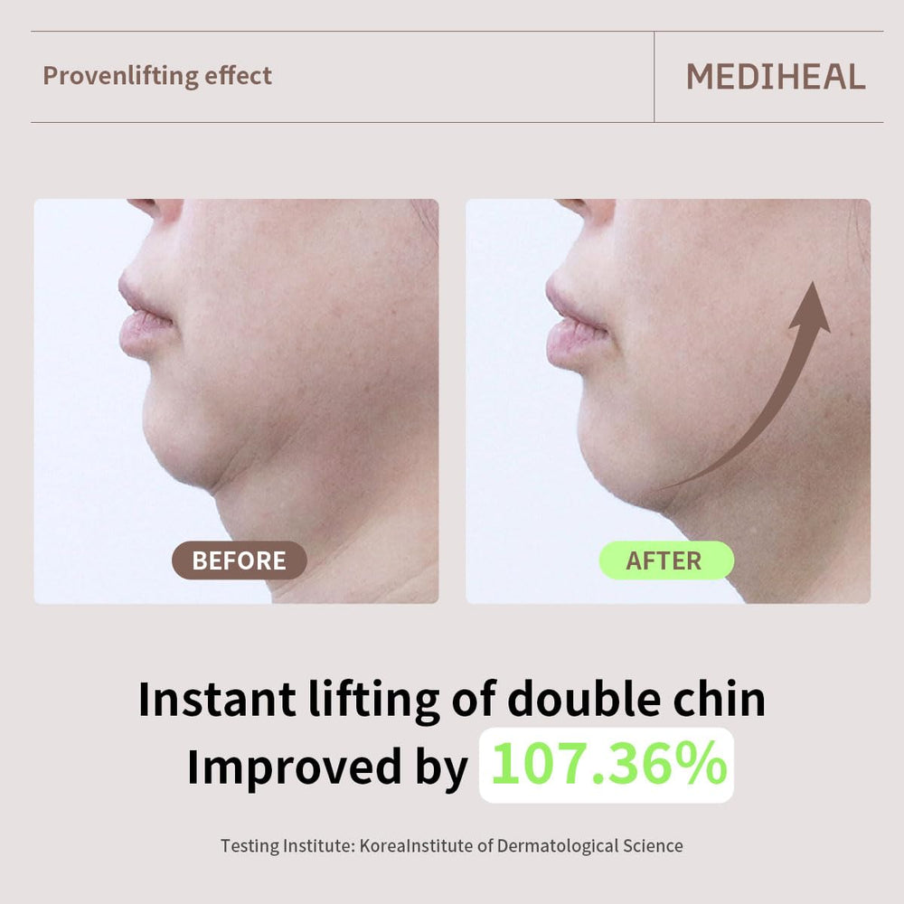 V-line area focus showing potential lifting around jawline with Mediheal mask