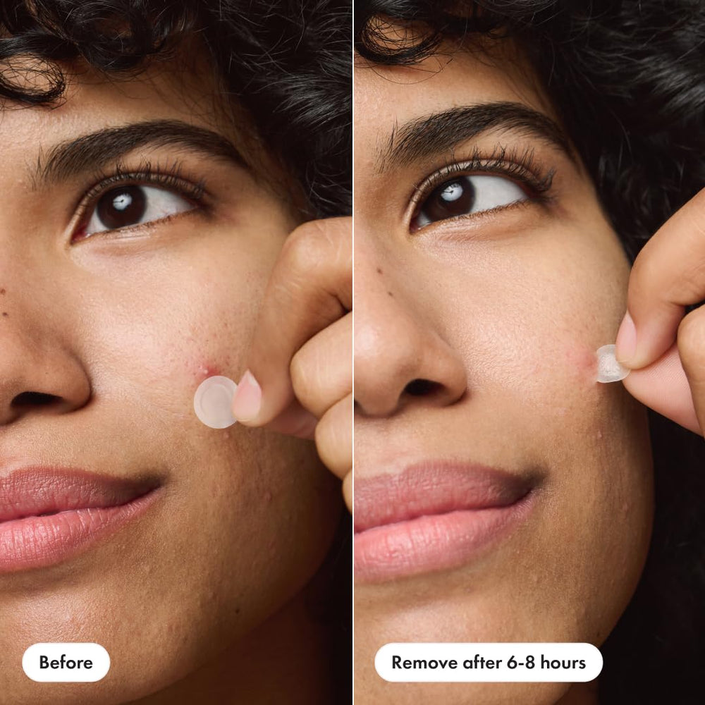 Mighty Patch Invisible+ adhesive keeps zit covered through activities