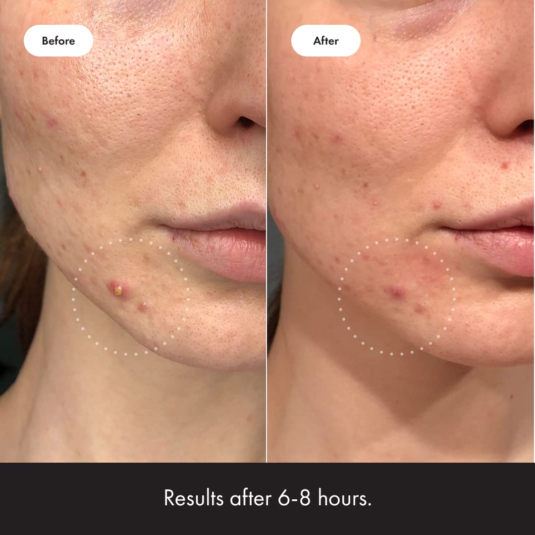 Mighty Patch Invisible+ medical-grade hydrocolloid close-up highlights skin-safe coverage