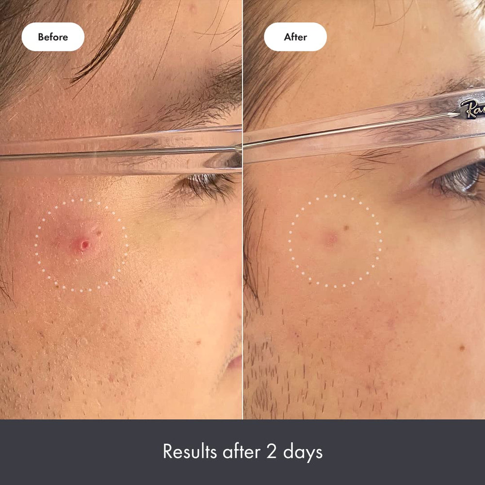 Mighty Patch Rescue Balm in-hand demonstrates easy post-patching recovery routine.
