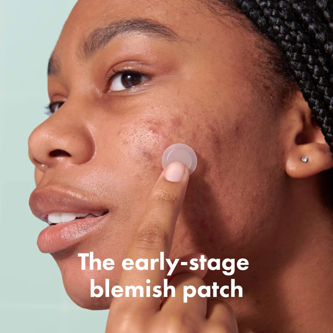 Mighty Patch Micropoint Large patch on blemish demonstrates discreet, breathable coverage