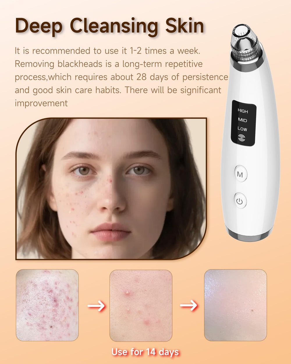 Miley blackhead remover vacuum used on face and nose for targeted cleansing.