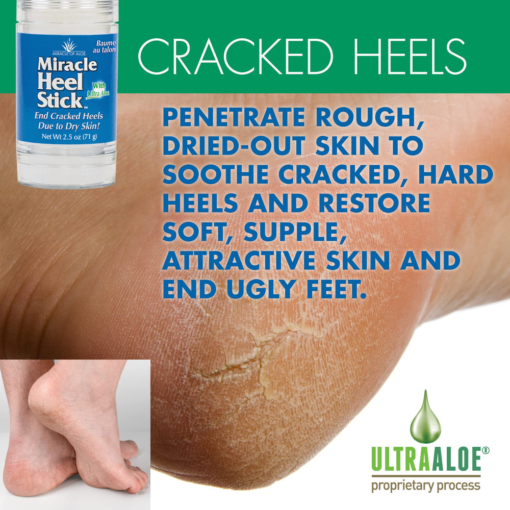 Miracle of Aloe cracked heel closeup highlights soothing hydration and repair prep