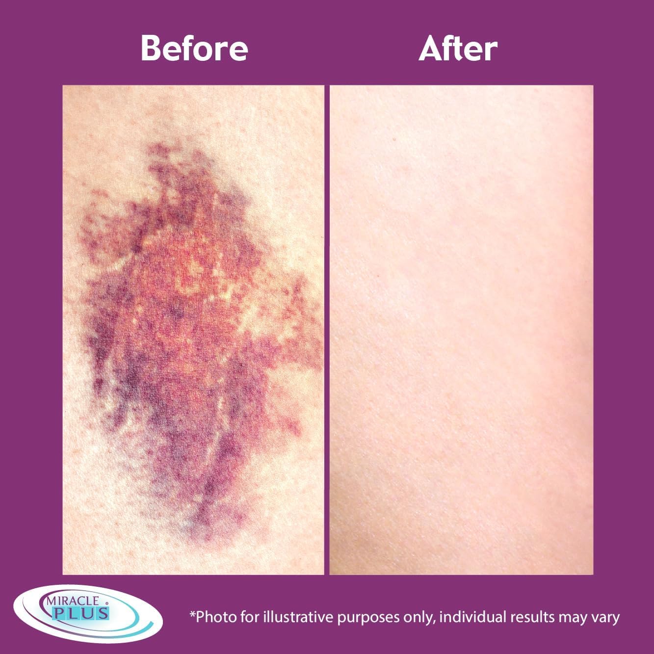 Miracle Plus 2pc set image featuring cream and gel for targeted bruising care