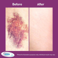 Miracle Plus 2pc set image featuring cream and gel for targeted bruising care