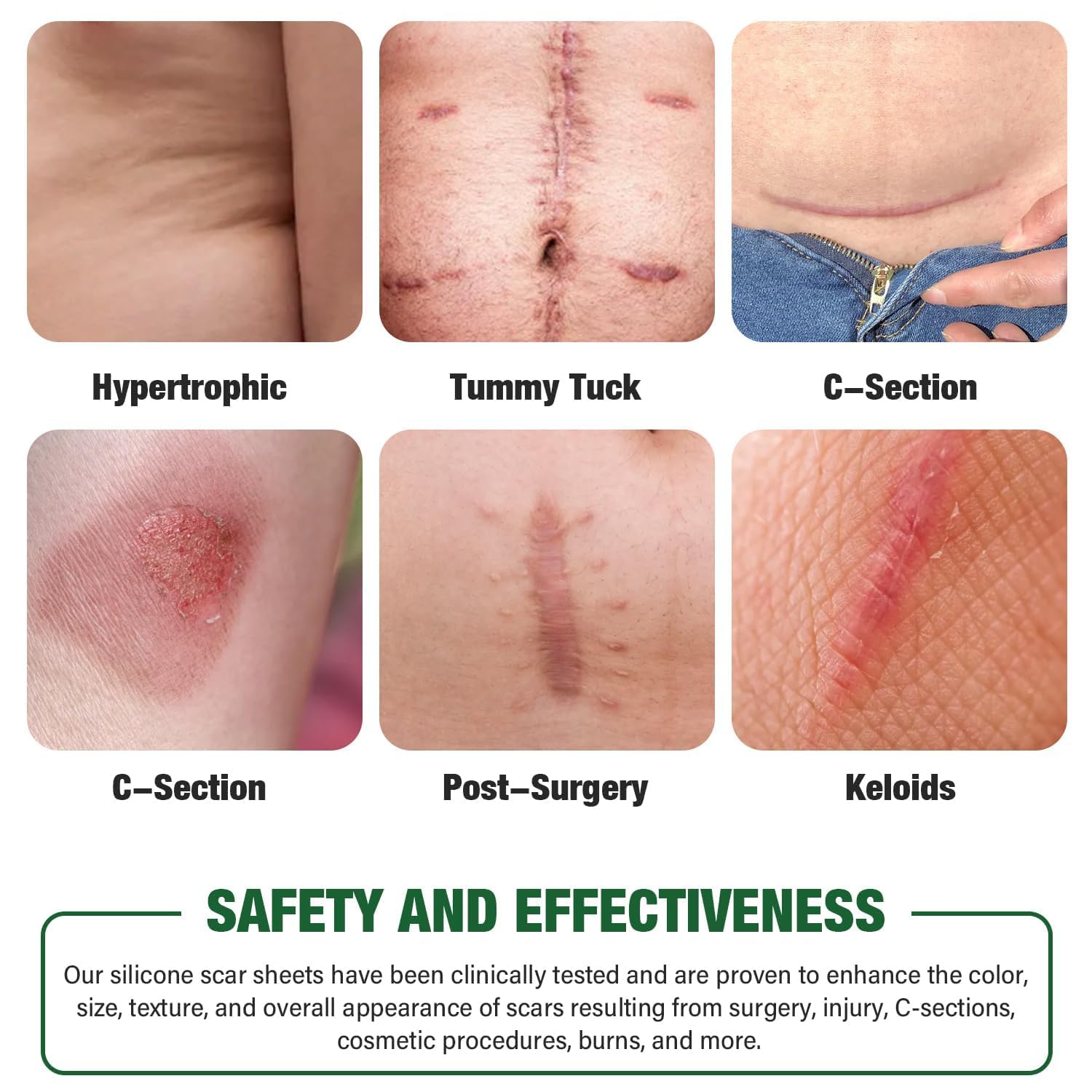 Mitreal silicone scar sheets worn day and night for continuous scar protection.