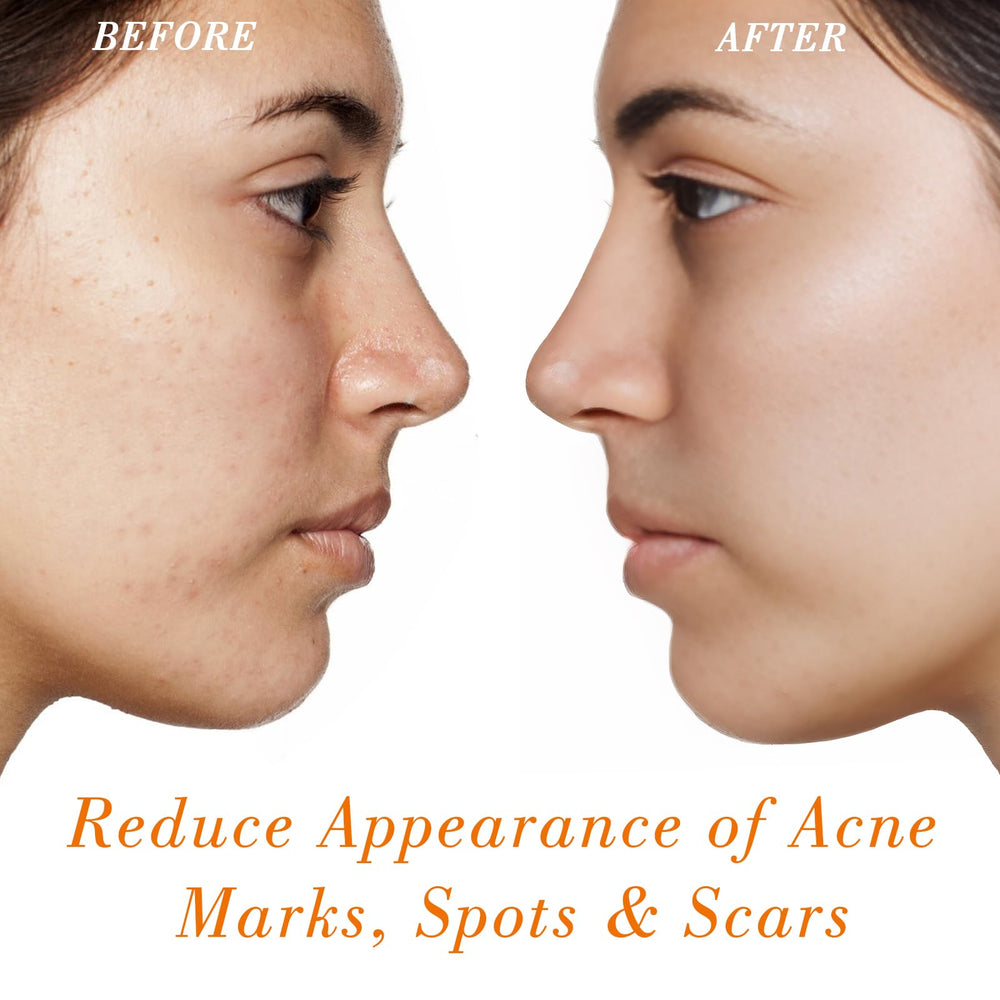 MMPANG Rosehip Oil on face during application promotes hydration and even tone.