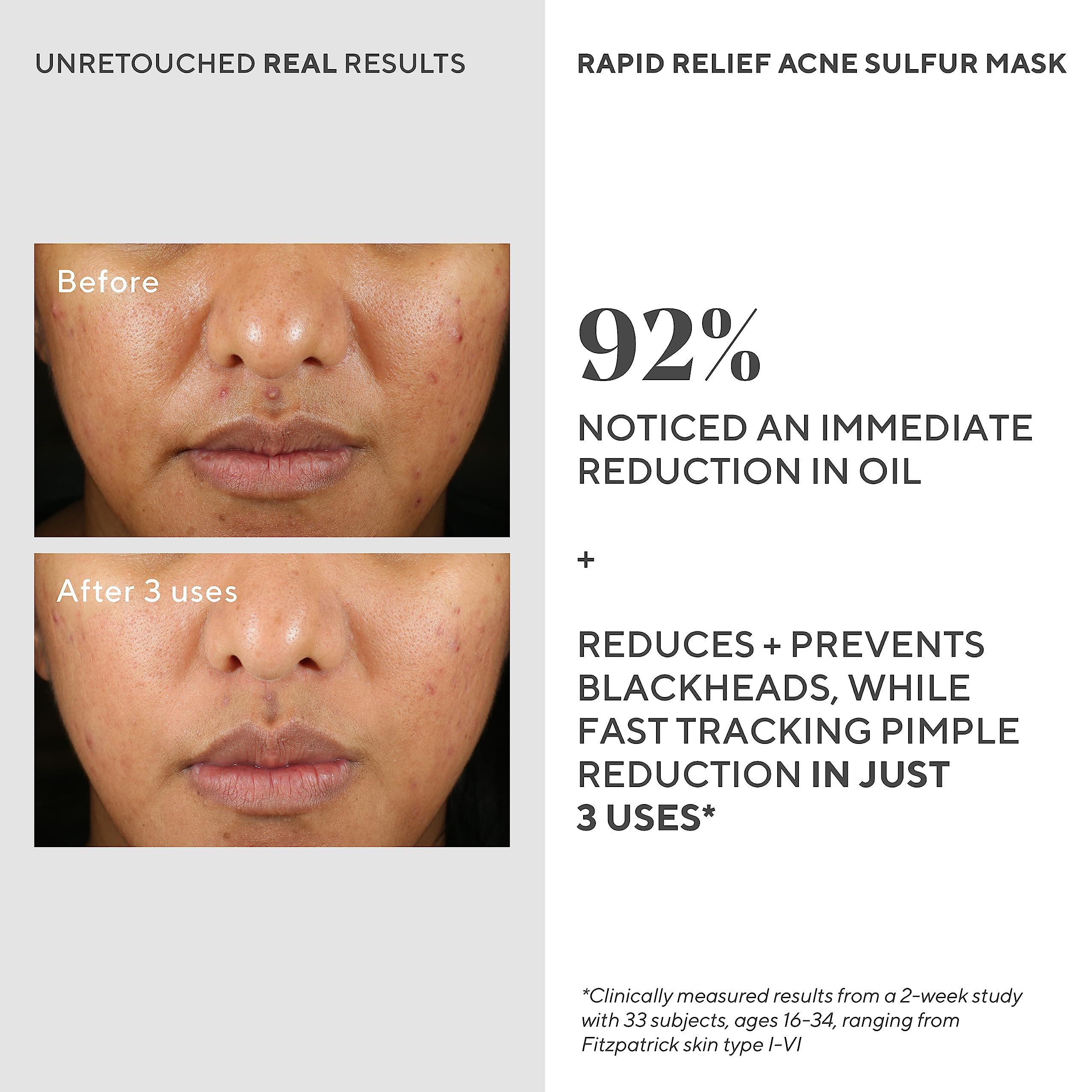 Applying Murad mask during a nighttime skincare routine for targeted breakout care.