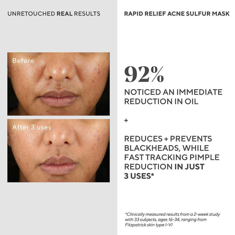 Applying Murad mask during a nighttime skincare routine for targeted breakout care.