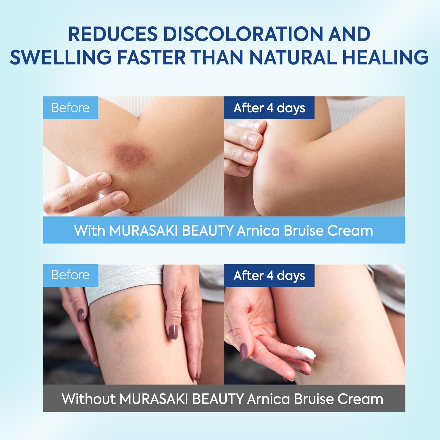 MURASAKI BEAUTY Arnica Bruise Cream applied to hands supports gentle daily bruise care.