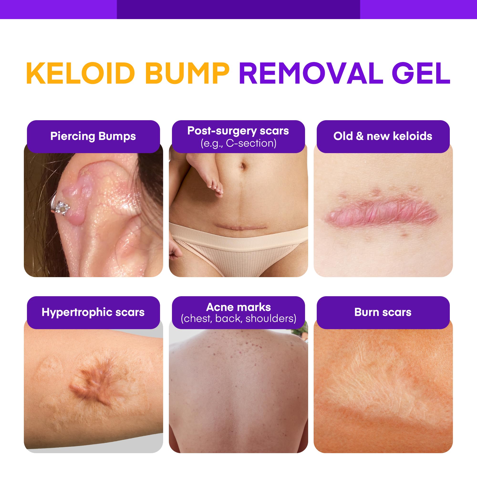MURASAKI BEAUTY Keloid Bump Gel ingredients label highlights ceramides and hyaluronic acid.