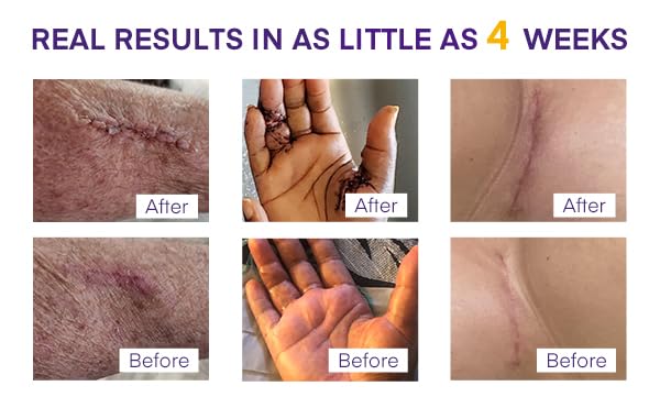 MURASAKI BEAUTY silicone scar gel 30g tube ready for daily use.