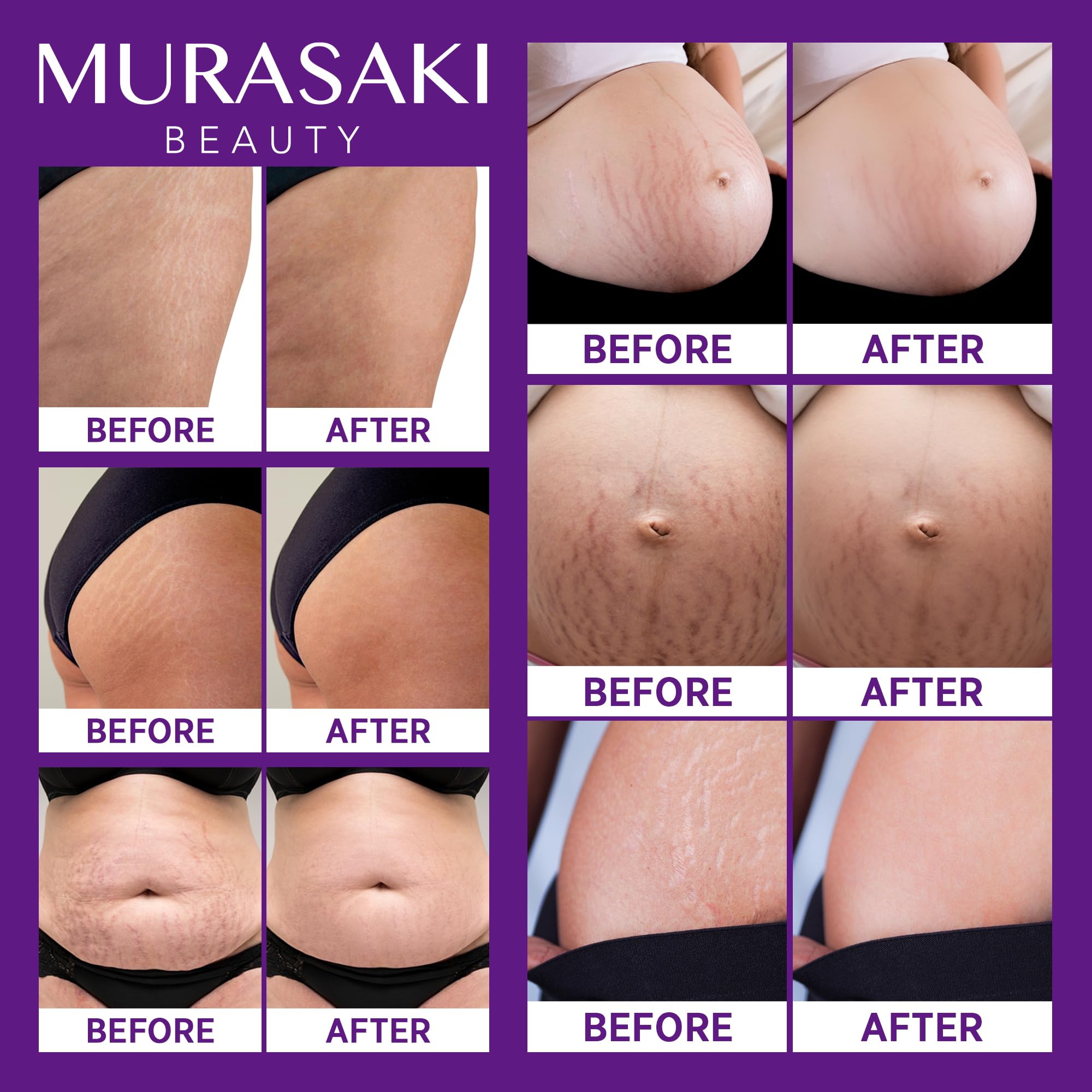 Murasaki Beauty stretch-mark cream hyaluronic acid emphasis for hydration
