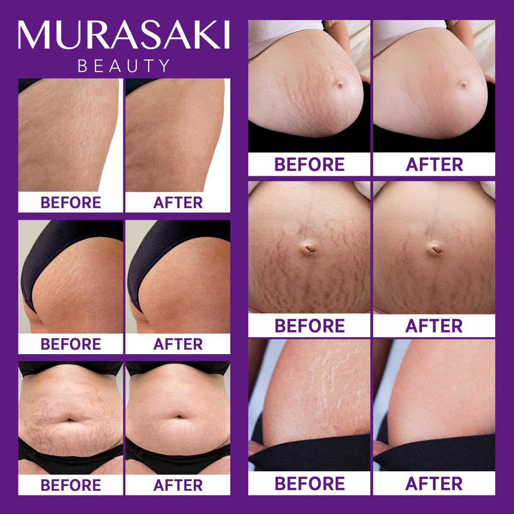 Murasaki Beauty stretch-mark cream hyaluronic acid emphasis for hydration