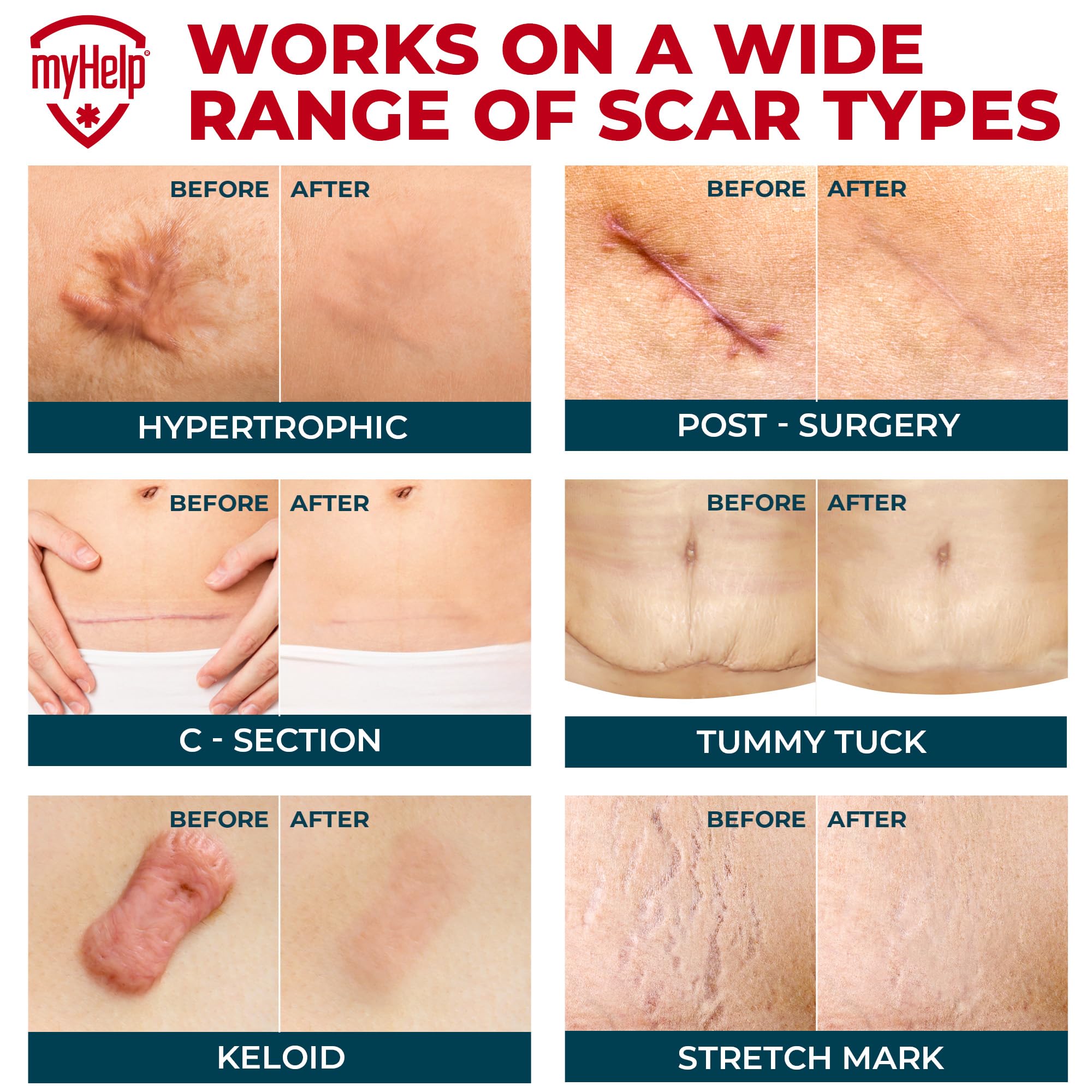MYHELP silicone scar patch on the knee stays secure during movement.