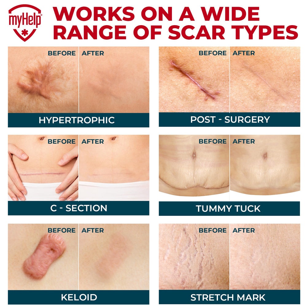 MYHELP silicone scar patch on the knee stays secure during movement.