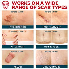 MYHELP silicone scar patch on the knee stays secure during movement.
