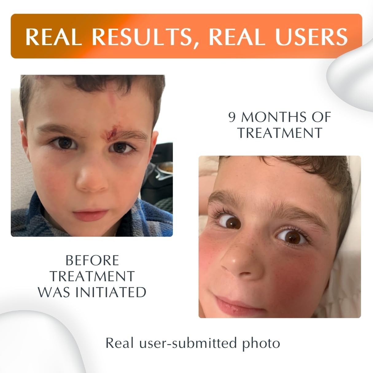 MyNewGel Plus UV applying on arm scar to protect from sun.