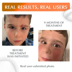MyNewGel Plus UV applying on arm scar to protect from sun.