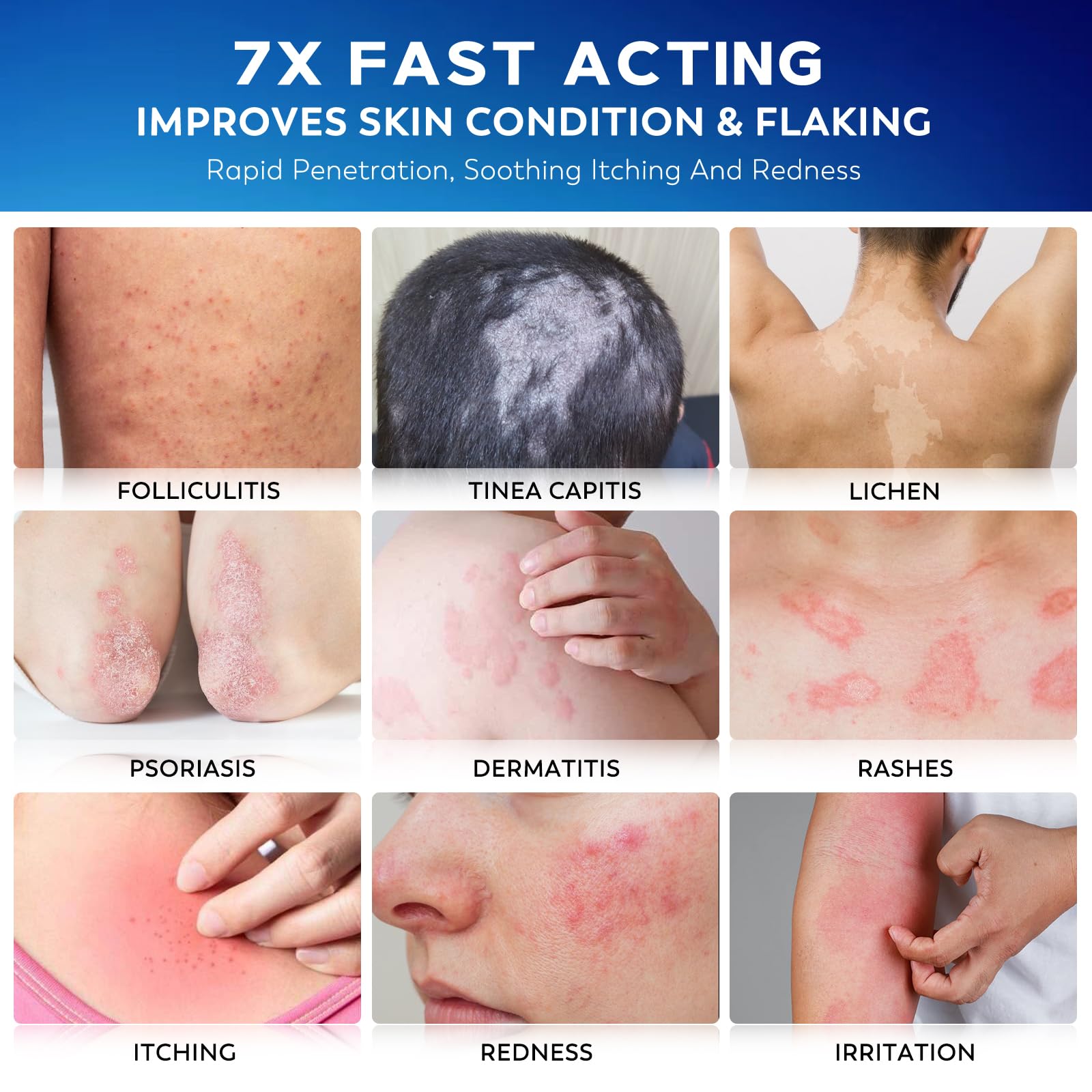 Nedtol Folliculitis Treatment Cream being dabbed on skin for gentle, non-greasy daily use.