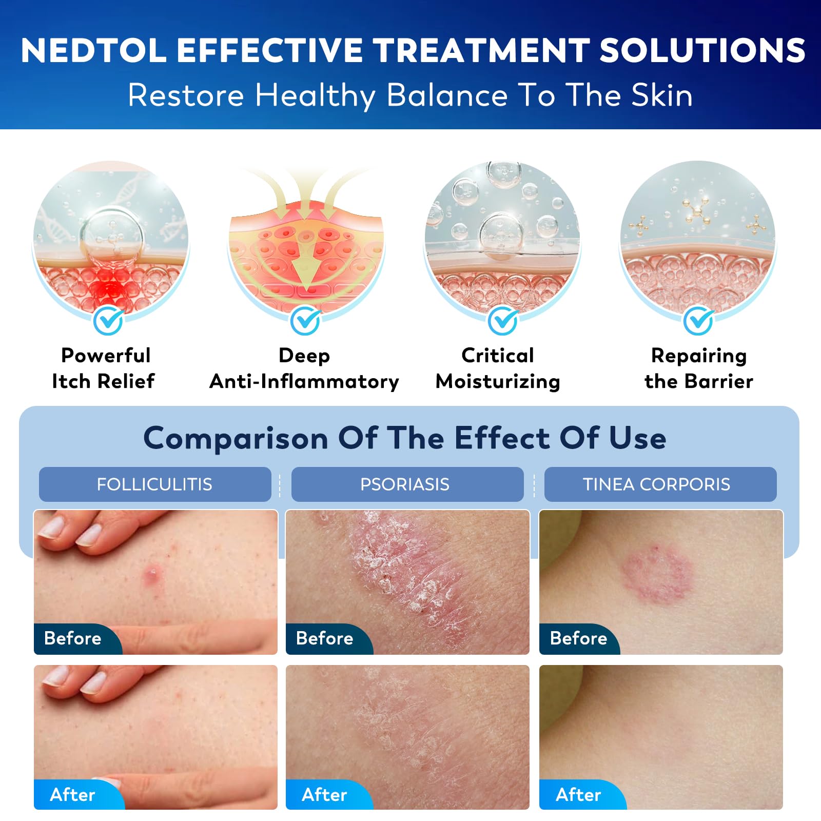 Nedtol packaging showing steroid-free herbal formula for sensitive skin.