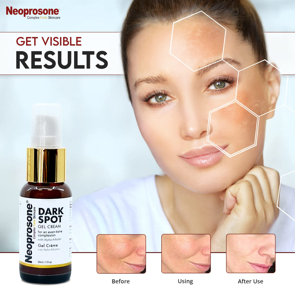Neoprosone crema-mancha-codos: reducción visual de manchas en codos ásperos.