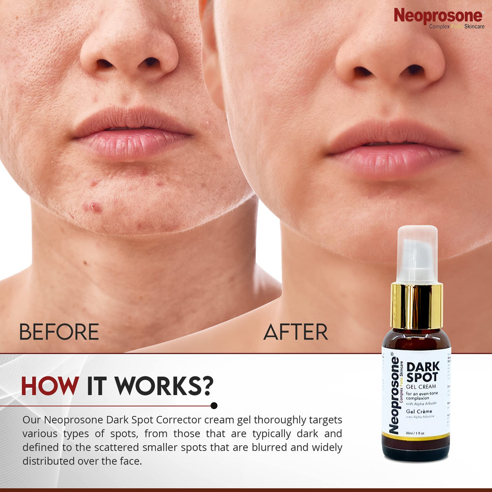 Neoprosone crema-mancha-rodillas: piel de rodillas con tono más parejo.