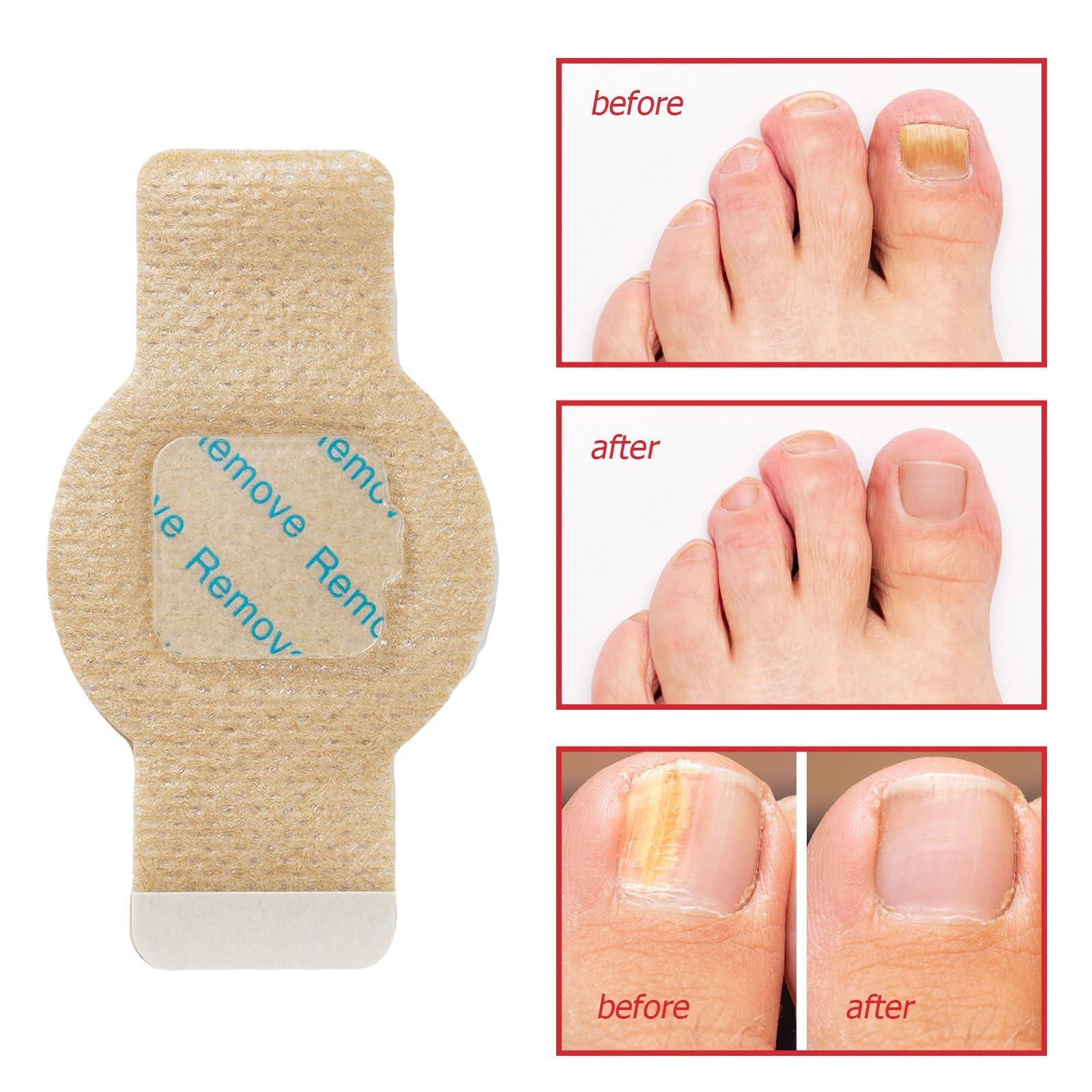 Nichalous Nail Patches adhesion around the nail edge demonstrates secure, mess-free wear.