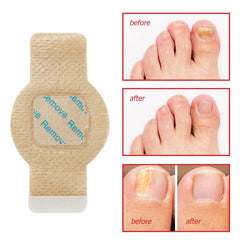 Nichalous Nail Patches adhesion around the nail edge demonstrates secure, mess-free wear.