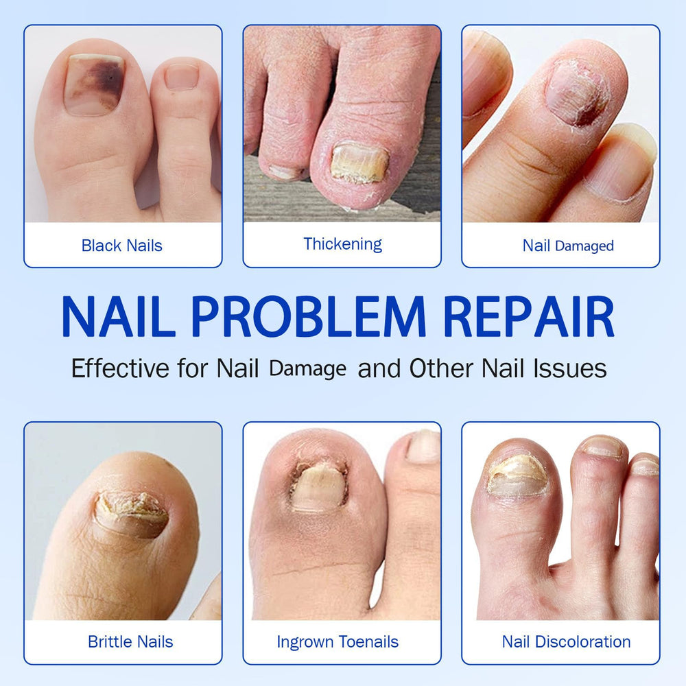 Nichalous Nail Patches hydrogel close-up highlights breathable adhesive.