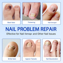 Nichalous Nail Patches hydrogel close-up highlights breathable adhesive.